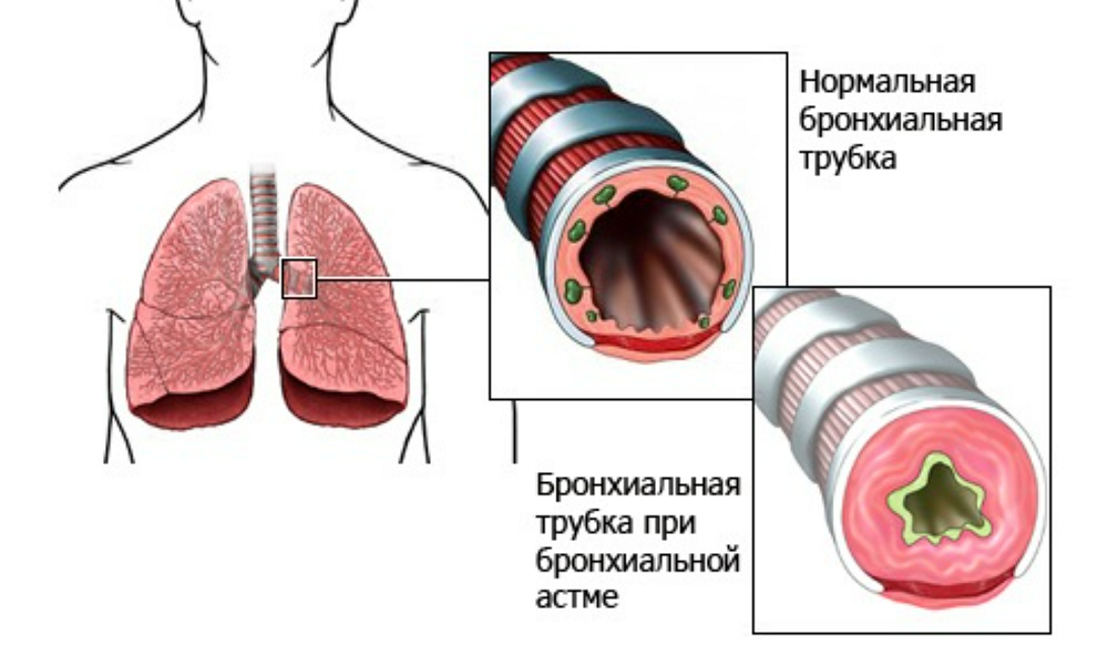 Бронхиальная трубка при астме